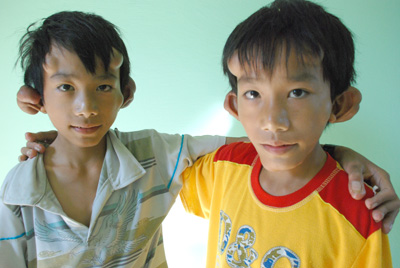 U xơ  thần kinh loại 2 - Hình ảnh minh họa